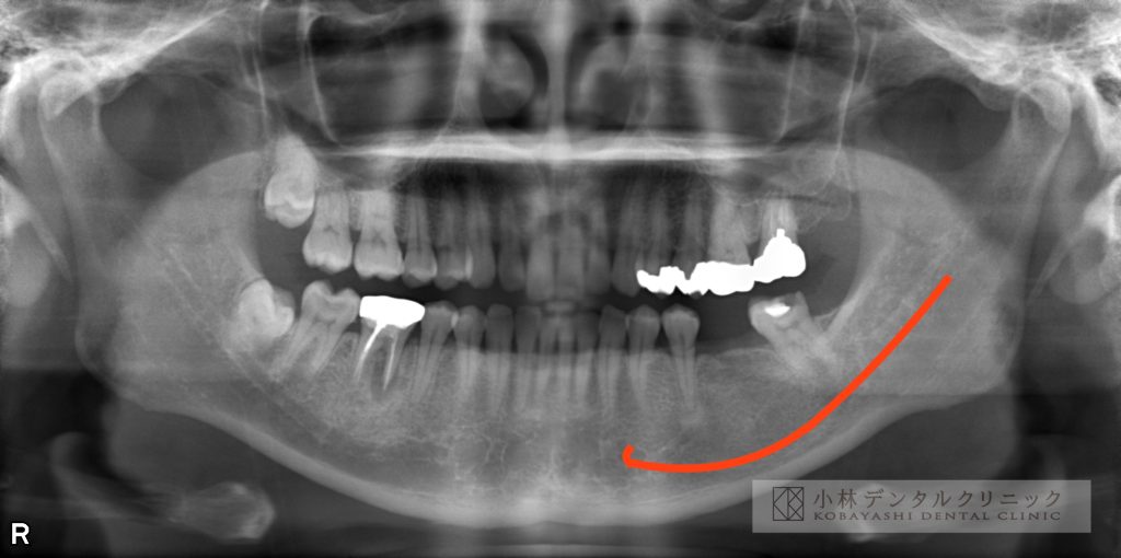 インプラント，大臼歯，術前，三田市，ストローマン，下顎管，下歯槽神経