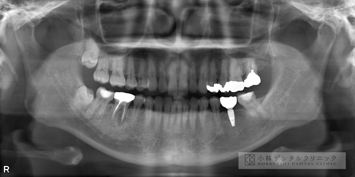 大臼歯のインプラント治療