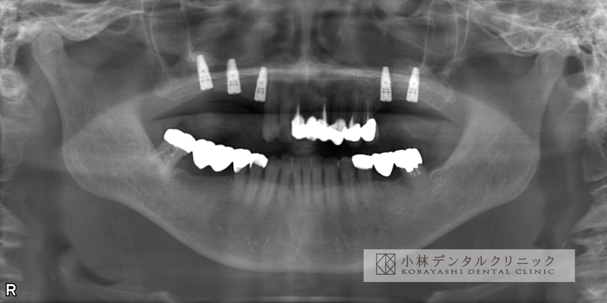 230大臼歯のインプラント治療