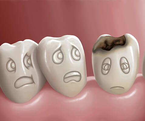 乳歯の虫歯を放置するリスク