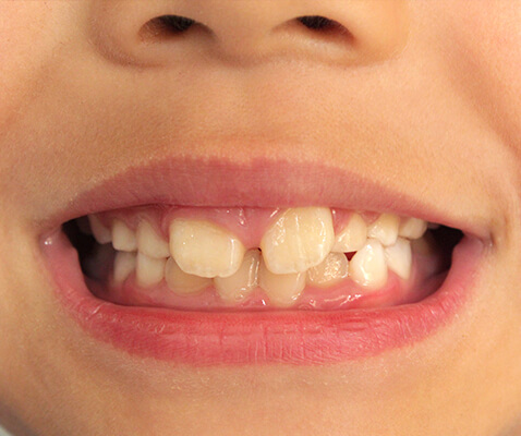 歯並びの乱れは予防できます