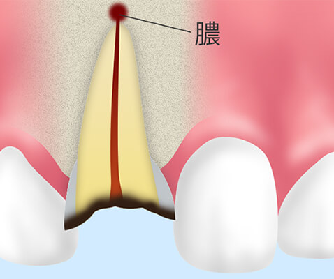 難治化した根尖性歯周炎への対応