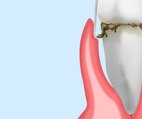 中等度の歯周病ルートプレーニング